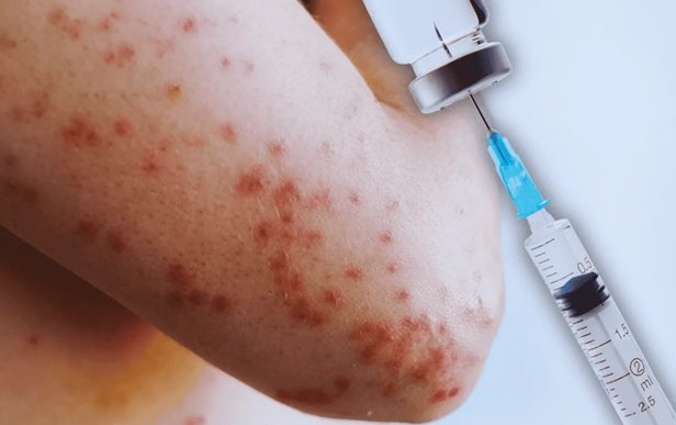 Alarma-a-dominicanos-en-NYC-aparicion-del-sarampion