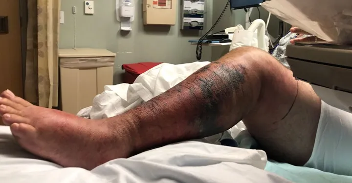 Encuentran-bacteria-carnivora-en-aguas-Long-Island-pueden-matar-personas-en-48-horas