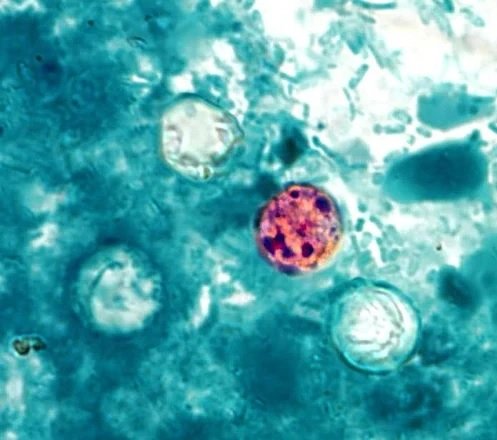 Parasito-ciclosporiasis-causa-grave-diarrea-aumenta-en-NYC-y-otros-estados_-dominicanos-en-alerta